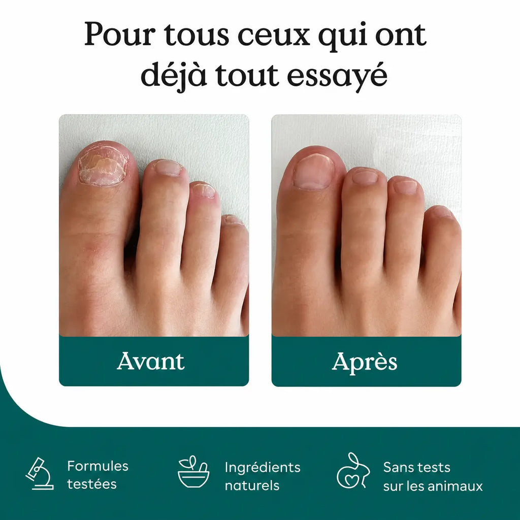 Stylo NailCare - Soin des Ongles Anti-Mycose