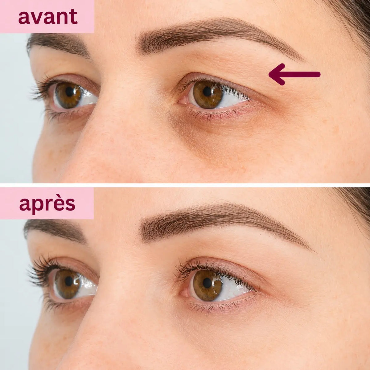 Patch Effet Lifting