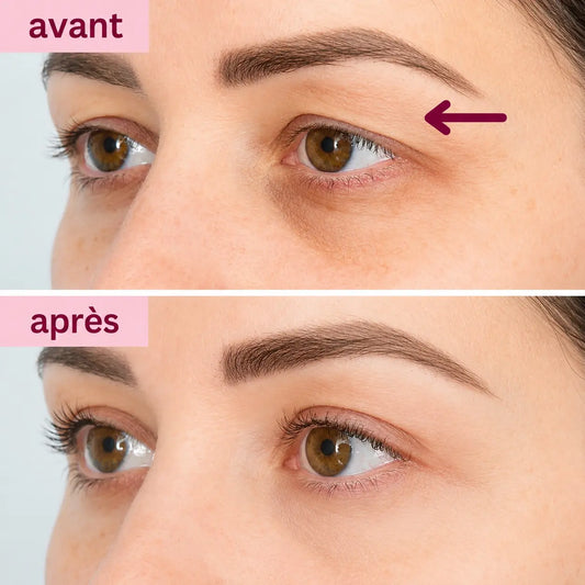 Patch Effet Lifting